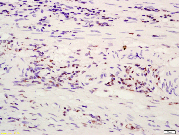 Formalin-fixed and paraffin embedded human rectal carcinoma labeled with Anti-ATF4\/CREB-2 Polyclonal Antibody, Unconjugated (bs-1531R) at 1:200 followed by conjugation to the secondary antibody and DAB staining