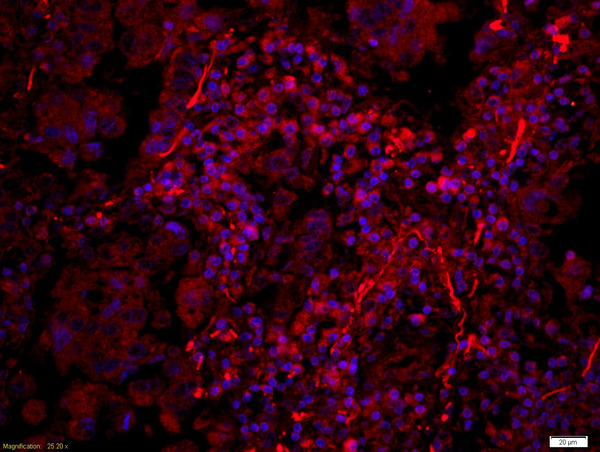 Formalin-fixed and paraffin-embedded human lung carcinoma labeled with Anti-Phospho-PERK(Thr980) Polyclonal Antibody, Unconjugated(bs-3330R) 1:200, overnight at 4°C, The secondary antibody was Goat Anti-Rabbit IgG, Cy3 conjugated(bs-0295G-Cy3)used at 1:200 dilution for 40 minutes at 37°C.