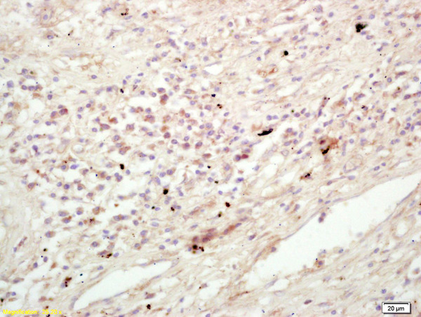 Formalin-fixed and paraffin embedded human lung carcinoma labeled with Rabbit Anti KIF11/Eg5/TRIP5 Polyclonal Antibody, Unconjugated (bs-8177R) at 1:200 followed by conjugation to the secondary antibody and DAB staining Formalin-fixed and paraffin embedded human lung carcinoma labeled with Rabbit Anti KIF11/Eg5/TRIP5 Polyclonal Antibody, Unconjugated (bs-8177R) at 1:200 followed by conjugation to the secondary antibody and DAB staining