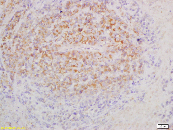 Formalin-fixed and paraffin embedded mouse lymphoma labeled with Anti-IL-3R alpha/CD123 Polyclonal Antibody, Unconjugated (bs-2600R) at 1:200 followed by conjugation to the secondary antibody and DAB staining