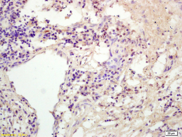 Formalin-fixed and paraffin embedded human colon carcinoma labeled with Rabbit Anti KIF11/Eg5/TRIP5 Polyclonal Antibody, Unconjugated (bs-8177R) at 1:200 followed by conjugation to the secondary antibody and DAB staining