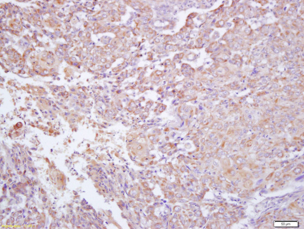 Formalin-fixed and paraffin embedded human labeled with Anti-IFNGR2 Polyclonal Antibody, Unconjugated (bs-2710R) at 1:200 followed by conjugation to the secondary antibody and DAB staining