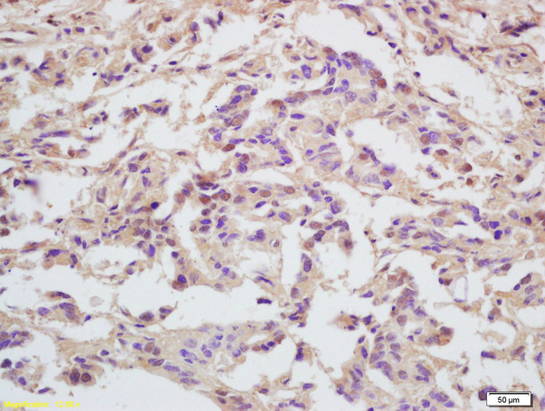 Formalin-fixed and paraffin embedded human gastric carcinoma labeled with Anti-MCM5 Polyclonal Antibody, Unconjugated (bs-2721R) at 1:200 followed by conjugation to the secondary antibody and DAB staining\n