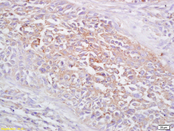 Formalin-fixed and paraffin embedded human lung carcinoma labeled with Rabbit Anti FRMD6 Polyclonal Antibody, Unconjugated (bs-8238R) at 1:200 followed by conjugation to the secondary antibody and DAB staining Formalin-fixed and paraffin embedded human lung carcinoma labeled with Rabbit Anti FRMD6 Polyclonal Antibody, Unconjugated (bs-8238R) at 1:200 followed by conjugation to the secondary antibody and DAB staining