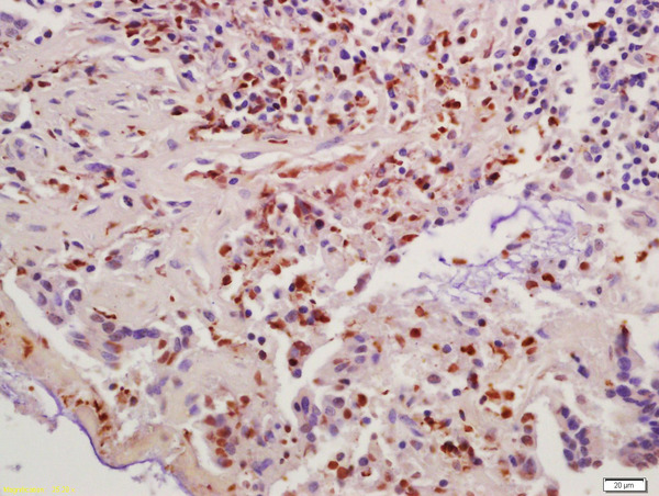 Formalin-fixed and paraffin embedded human colon carcinoma labeled with Anti-Cyclin B1 Polyclonal Antibody, Unconjugated (bs-0572R) at 1:200 followed by conjugation to the secondary antibody and DAB staining