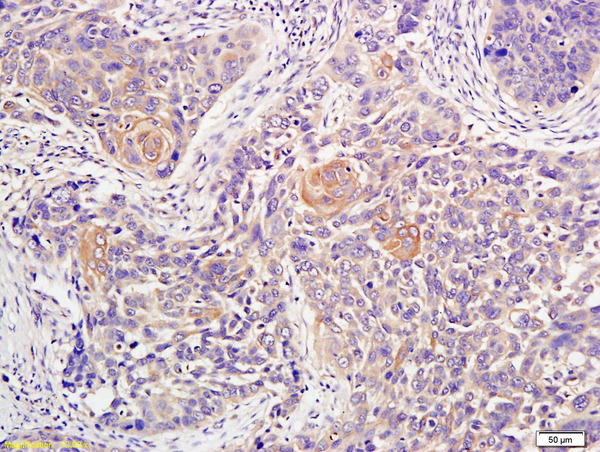 Formalin-fixed and paraffin embedded human lung carcinoma labeled with Anti-ATM Polyclonal Antibody, Unconjugated (bs-1370R) at 1:200 followed by conjugation to the secondary antibody and DAB staining\\n