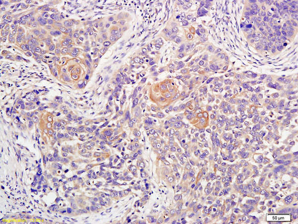 Formalin-fixed and paraffin embedded human lung carcinoma labeled with Anti-ATM Polyclonal Antibody, Unconjugated (bs-1370R) at 1:200 followed by conjugation to the secondary antibody and DAB staining\n Formalin-fixed and paraffin embedded human lung carcinoma labeled with Anti-ATM Polyclonal Antibody, Unconjugated (bs-1370R) at 1:200 followed by conjugation to the secondary antibody and DAB staining\n