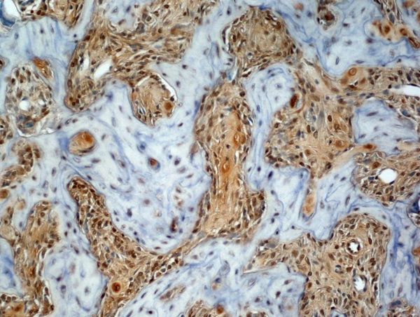 Generously provided by Markus Linder from Medical University Vienna as part of the Bioss Discovery Program. Formalin-fixed, paraffin embedded, and decalcified in EDTA mouse osteosarcoma labeled with Anti-Osteocalcin Polyclonal Antibody, Unconjugated (bs-0470R) at 1:100 followed by conjugation to the secondary antibody and DAB staining