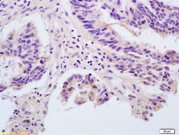 Formalin-fixed and paraffin embedded human rectal carcinoma labeled with Rabbit Anti ANGPTL1/Angiopoietin 1/ANG-1 Polyclonal Antibody, Unconjugated (bs-0800R) at 1:200 followed by conjugation to the secondary antibody and DAB staining