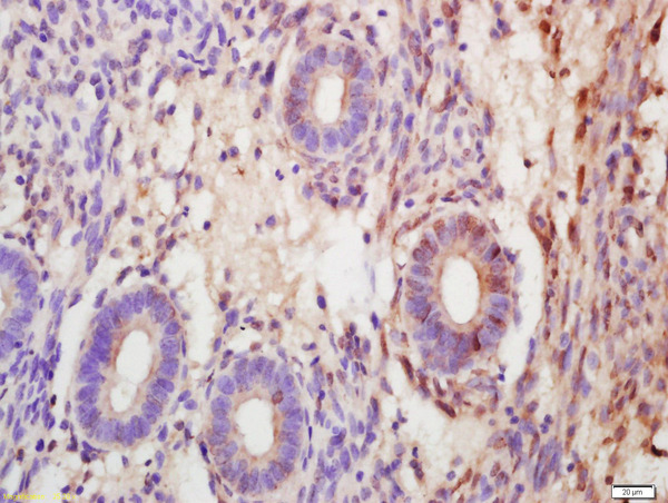 Formalin-fixed and paraffin embedded human endometrial carcinoma labeled with Anti-SOX7 Polyclonal Antibody, Unconjugated (bs-12277R) at 1:200 followed by conjugation to the secondary antibody and DAB staining