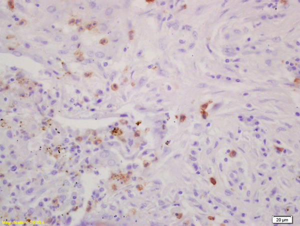 Formalin-fixed and paraffin embedded human lung carcinoma labeled with Rabbit Anti CD79A/IGBP-1 Polyclonal Antibody, Unconjugated (bs-0298R) at 1:200 followed by conjugation to the secondary antibody and DAB staining