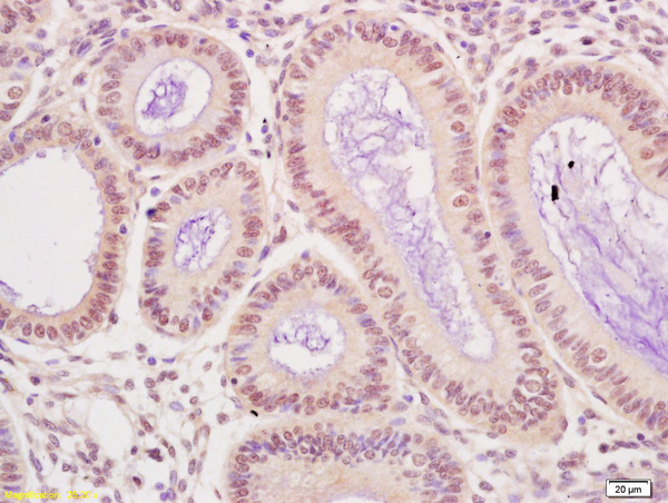 Formalin-fixed and paraffin embedded human breast carcinoma labeled with Anti-UBE3A/E6-AP Polyclonal Antibody, Unconjugated (bs-11776R) at 1:200 followed by conjugation to the secondary antibody and DAB staining