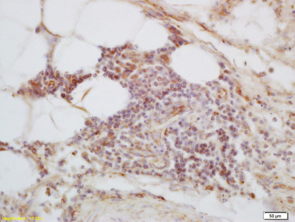 Formalin-fixed and paraffin embedded human lung carcinoma labeled with Anti-C1orf106 Polyclonal Antibody, Unconjugated (bs-15004R) at 1:200 followed by conjugation to the secondary antibody and DAB staining