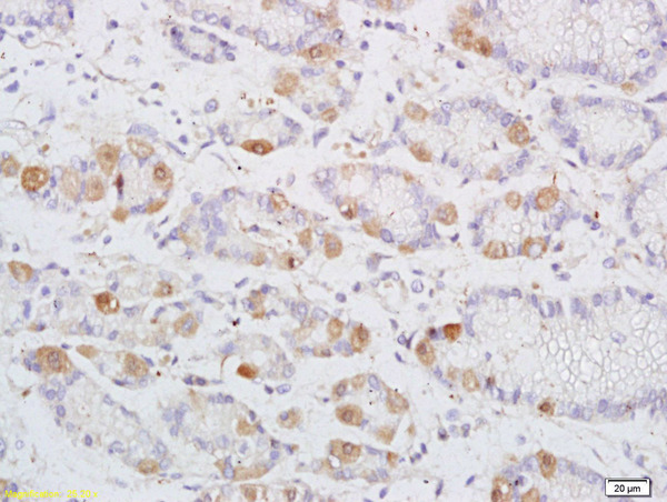 Formalin-fixed and paraffin embedded human colon carcinoma labeled with Anti-DENND2D Polyclonal Antibody, Unconjugated (bs-9668R) at 1:200 followed by conjugation to the secondary antibody and DAB staining\n
