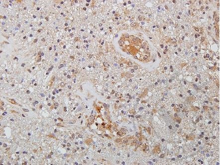 Images provided the Independent Validation Program (badge number 029629)Formalin-fixed and paraffin embedded human brain glioma tissue labeled with Rabbit Anti-WNT2 Polyclonal Antibody (bs-6133R) at 1:250 overnight at 4 \u00b0C followed by conjugation to secondary antibody.