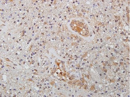 Images provided the Independent Validation Program (badge number 029629)Formalin-fixed and paraffin embedded human brain glioma tissue labeled with Rabbit Anti-WNT2 Polyclonal Antibody (bs-6133R) at 1:250 overnight at 4 °C followed by conjugation to secondary antibody.