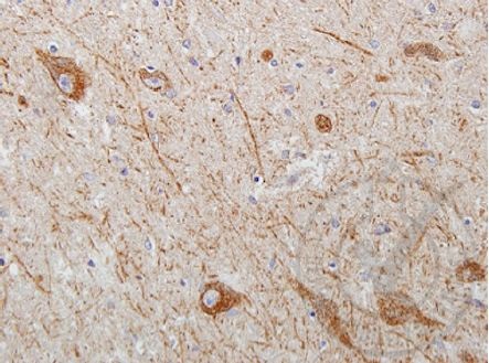 Images provided the Independent Validation Program (badge number 029629)Formalin-fixed and paraffin embedded human brain tissue with Parkinson's morphology labeled with Rabbit Anti-WNT2 Polyclonal Antibody (bs-6133R) at 1:250 overnight at 4 \u00b0C followed by conjugation to secondary antibody.