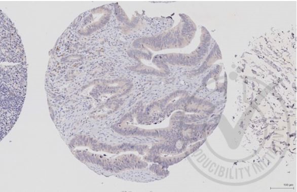 Images provided the Independent Validation Program (badge number 29651)Formalin-fixed and paraffin embedded human colon labeled with Rabbit Anti-c-Raf/Raf1 Polyclonal Antibody (bs-1703R) at 1:250 overnight at room temperature followed by conjugation to secondary antibody.