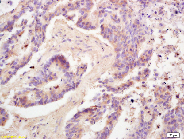 Formalin-fixed and paraffin embedded human colon carcinoma labeled with  Rabbit Anti Adiponectin Polyclonal Antibody, Unconjugated (bs-0471R) at 1:200 followed by conjugation to the secondary antibody and DAB staining