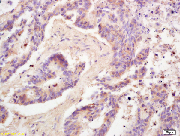 Formalin-fixed and paraffin embedded human colon carcinoma labeled with Rabbit Anti Adiponectin Polyclonal Antibody, Unconjugated (bs-0471R) at 1:200 followed by conjugation to the secondary antibody and DAB staining