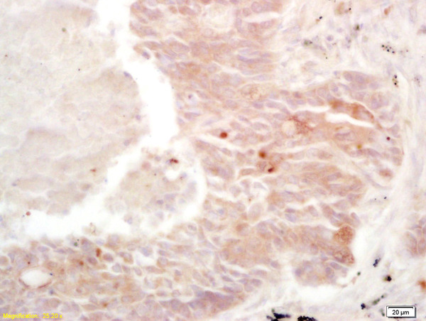 Formalin-fixed and paraffin embedded human lung carcinoma labeled with Rabbit Anti Cullin/C10orf46 Polyclonal Antibody, Unconjugated (bs-0614R) at 1:200 followed by conjugation to the secondary antibody and DAB staining