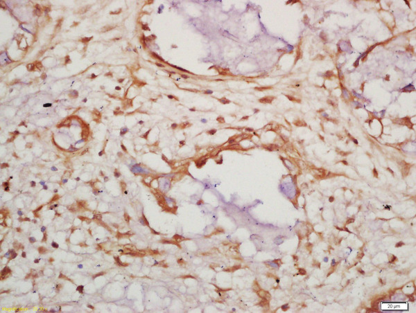 Formalin-fixed and paraffin embedded human lung carcinoma labeled with Anti-Caspase 14 Polyclonal Antibody, Unconjugated (bs-10136R) at 1:200 followed by conjugation to the secondary antibody and DAB staining\\n