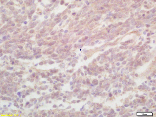 Formalin-fixed and paraffin embedded human lung carcinoma labeled with Rabbit Anti ZNF268 Polyclonal Antibody, Unconjugated (bs-0626R) at 1:200 followed by conjugation to the secondary antibody and DAB staining