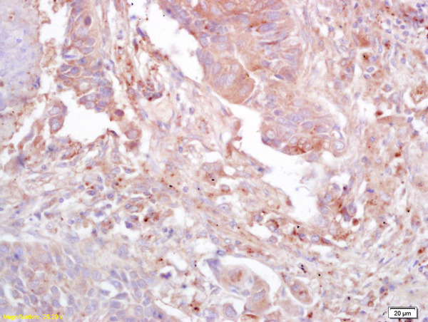 Formalin-fixed and paraffin embedded human lung carcinoma labeled with Anti-GnRHR Polyclonal Antibody, Unconjugated (bs-3159R) at 1:200 followed by conjugation to the secondary antibody and DAB staining