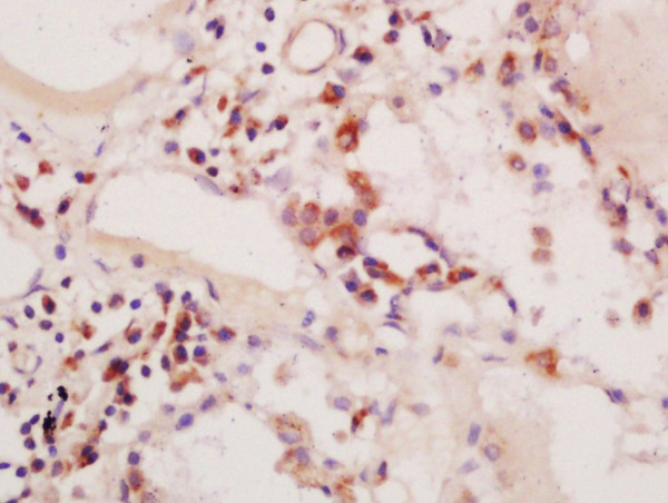 Formalin-fixed and paraffin embedded human colon carcinoma labeled with Anti-phospho-PIK3C3(Ser164)Polyclonal Antibody, Unconjugated (bs-5581R) at 1:200 followed by conjugation to the secondary antibody and DAB staining