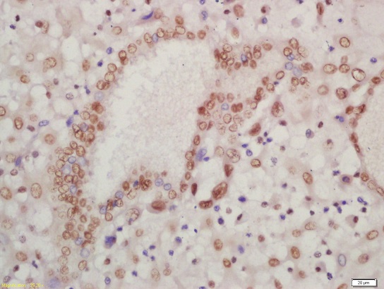 Formalin-fixed and paraffin embedded human placenta labeled with Rabbit Anti-HOXA13 Polyclonal Antibody, Unconjugated (bs-12244R) at 1:200 followed by conjugation to the secondary antibody and DAB staining\n