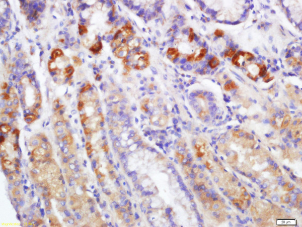 Formalin-fixed and paraffin embedded human gastric carcinoma labeled with Rabbit Anti-EDA2R Polyclonal Antibody, Unconjugated (bs-7111R) at 1:200 followed by conjugation to the secondary antibody and DAB staining\n