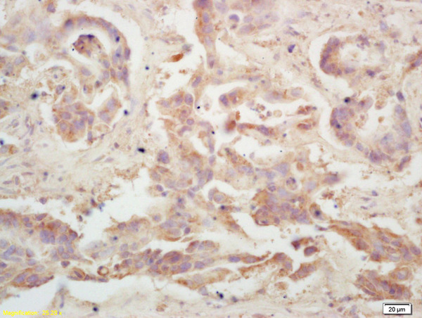Formalin-fixed and paraffin embedded human colon carcinoma labeled with  Rabbit Anti LRP\/MVP Polyclonal Antibody, Unconjugated (bs-0661R) at 1:200 followed by conjugation to the secondary antibody and DAB staining