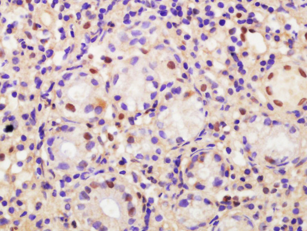 Formalin-fixed and paraffin embedded human gastric carcinoma labeled with Anti-CDCA2 Polyclonal Antibody, Unconjugated (bs-7786R) at 1:200 followed by conjugation to the secondary antibody and DAB staining