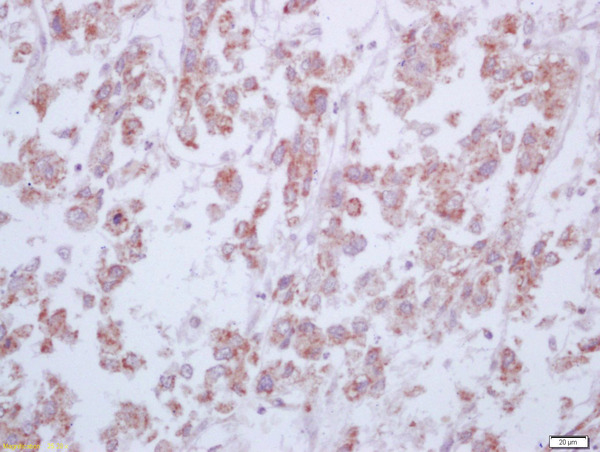 Formalin-fixed and paraffin embedded human liver carcinoma labeled with Anti-Arginase 1 Polyclonal Antibody, Unconjugated (bs-8585R) at 1:200 followed by conjugation to the secondary antibody and DAB staining