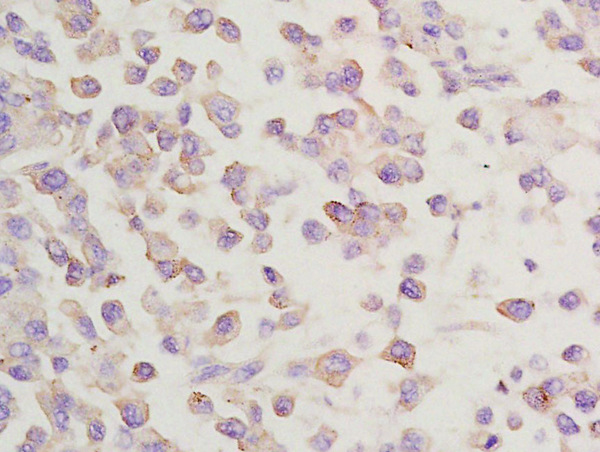 Formalin-fixed and paraffin embedded rat lung carcinoma labeled with Anti-GGA2 Polyclonal Antibody, Unconjugated (bs-13344R) at 1:200 followed by conjugation to the secondary antibody and DAB staining\n