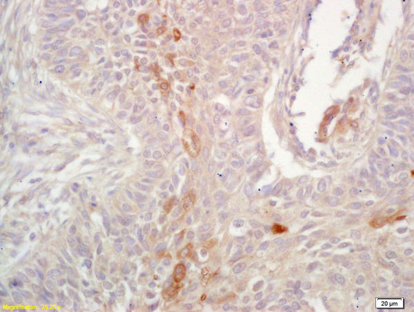 Formalin-fixed and paraffin embedded human lung carcinoma labeled with  Rabbit Anti HLA-G Polyclonal Antibody, Unconjugated (bs-0753R) at 1:200 followed by conjugation to the secondary antibody and DAB staining