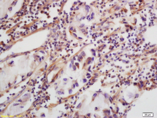 Formalin-fixed and paraffin embedded human colon carcinoma labeled with Rabbit Anti-CLEC5A/MDL1 Polyclonal Antibody (bs-2663R) at 1:200 followed by conjugation to the secondary antibody and DAB staining.
