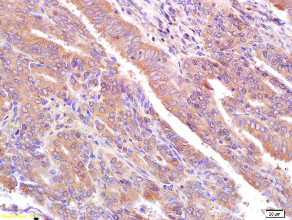 Formalin-fixed and paraffin embedded human breast cancer labeled with Rabbit Anti CA153/EMA/Mucin 1 Polyclonal Antibody, Unconjugated (bs-1239R) at 1:200 followed by conjugation to the secondary antibody and DAB staining