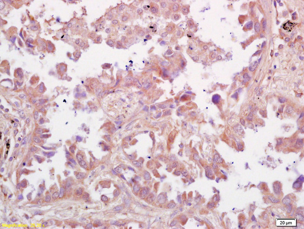 Formalin-fixed and paraffin embedded human lung carcinoma labeled with  Rabbit Anti RSV Polyclonal Antibody, Unconjugated (bs-1264R) at 1:200 followed by conjugation to the secondary antibody and DAB staining