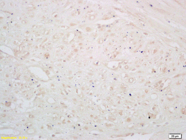 Formalin-fixed and paraffin embedded human breast carcinoma labeled with Rabbit Anti GABBR2/GB2/GABA B Receptor 2 Polyclonal Antibody, Unconjugated (bs-1293R) at 1:200 followed by conjugation to the secondary antibody and DAB staining