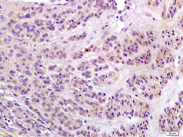 Formalin-fixed and paraffin embedded human endometrial carcinoma labeled with Anti-Notch1/MOTC Polyclonal Antibody, Unconjugated (bs-1335R) at 1:200 followed by conjugation to the secondary antibody and DAB staining