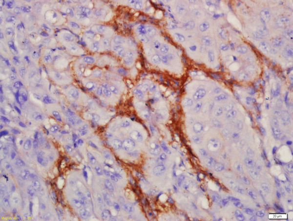 Formalin-fixed and paraffin embedded human laryngocarcinoma labeled with Anti-EGFRvIII Polyclonal Antibody, Unconjugated (bs-2558R) at 1:200 followed by conjugation to the secondary antibody and DAB staining