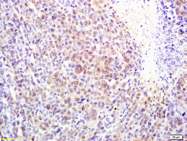 Formalin-fixed and paraffin embedded mouse lymphoma labeled with Rabbit Anti alpha MSH Polyclonal Antibody, Unconjugated (bs-1848R) at 1:200 followed by conjugation to the secondary antibody and DAB staining