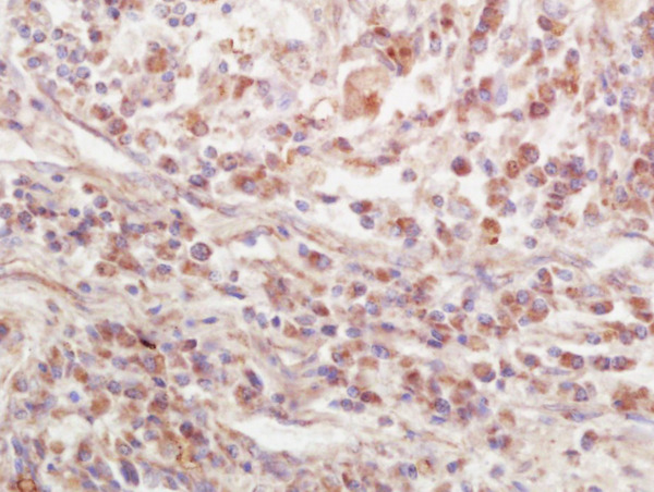 Formalin-fixed and paraffin embedded human lung carcinoma labeled with Rabbit Anti-EPS15R Polyclonal Antibody, Unconjugated (bs-13100R) at 1:200 followed by conjugation to the secondary antibody and DAB staining