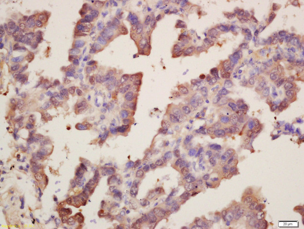 Formalin-fixed and paraffin embedded human lung carcinoma labeled with Rabbit Anti-SOD1 Polyclonal Antibody, Unconjugated (bs-10216R) at 1:200 followed by conjugation to the secondary antibody and DAB staining\n