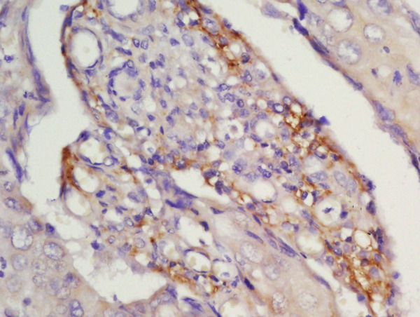 Formalin-fixed and paraffin embedded human laryngocarcinoma labeled with Rabbit Anti-CCR7\/CD197 Polyclonal Antibody, Unconjugated (bs-1305R) at 1:200 followed by conjugation to the secondary antibody and DAB staining