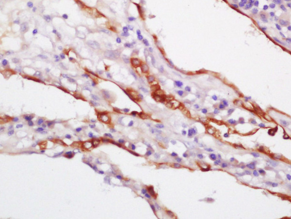 Formalin-fixed and paraffin embedded human lung carcinoma labeled with Rabbit Anti-CK18 Polyclonal Antibody,Unconjugated (bs-1339R) at 1:200 followed by conjugation to the secondary antibody and DAB staining\n