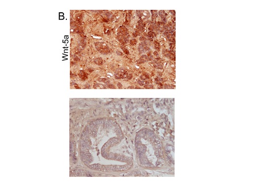 Image kindly submitted by Dr. Magdalena Krol. Formalin-fixed and paraffin embedded canine mammary tumor labeled with Rabbit Anti-WNT5A Polyclonal Antibody, Unconjugated (bs-1948R) at 1:200 followed by conjugation to the secondary antibody and DAB staining