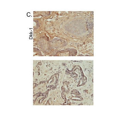 Image kindly submitted by Dr. Magdalena Krol. Formalin-fixed and paraffin embedded canine mammary tumor labeled with Rabbit Anti-DKK1 Polyclonal Antibody, Unconjugated (bs-2162R) at 1:200 followed by conjugation to the secondary antibody and DAB staining