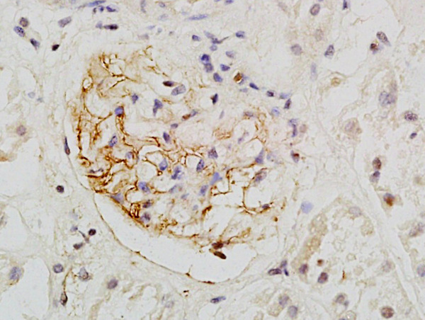 Formalin-fixed and paraffin embedded human kidney labeled with Rabbit Anti-PCX/PODXL Polyclonal Antibody, Unconjugated (bs-1345R) at 1:200 followed by conjugation to the secondary antibody and DAB staining Formalin-fixed and paraffin embedded human kidney labeled with Rabbit Anti-PCX/PODXL Polyclonal Antibody, Unconjugated (bs-1345R) at 1:200 followed by conjugation to the secondary antibody and DAB staining